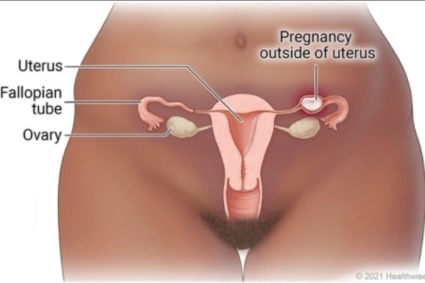 Ectopic Pregnancy